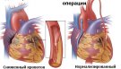 Операция коронарного шунтирования